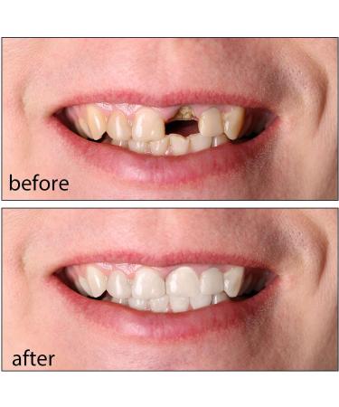 Instant Cosmetic Dentures - 2 Pairs Temporary False Teeth & Whitening Repair Kit | International Shipping - Buy Online on GoSupps.com