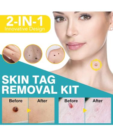 2-in-1 Skin Tag & Mole Remover Kit - Safe & Painless Removal for 2mm-8mm Sized Tags - Easy DIY at Home Green - Buy Online on GoSupps.com