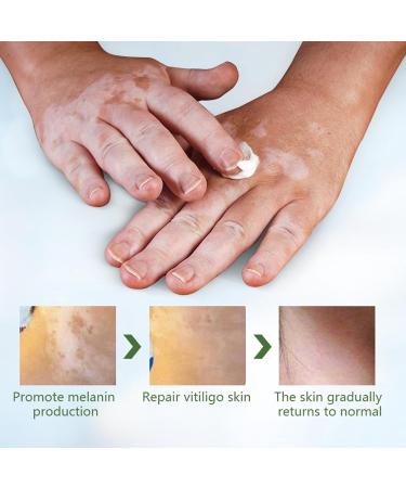 Bploar Vitiligo Cream white spot cream improves skin pigmentation skin therapy cream treats skin problems effectively moisturizes and cares suitable for all skin types - Buy Online on GoSupps.com