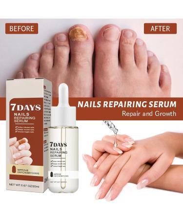 7 Day Nail Growth and Strengthening Serum Nail Growth and Strengthening Serum Nail Growth and Strengthening Serum Repair Dam - Buy Online on GoSupps.com