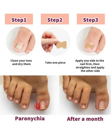 Fertoe Toenail Corrector Patch - 100pcs Ingrown Toenail Correction Strips for Painless Pedicure - Buy Online on GoSupps.com