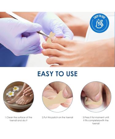 Ingrown Toenail Treatment - 100Pcs Breathable Corrector Patches & Strips | Pain-Free Nail Correction Durable Light Brown Stickers for Effective Ingrown Nail Care - Buy Online on GoSupps.com