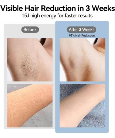 Lescolton Sapphire IPL Hair Removal - Painless ICE Cooling Tech 3 Replacement Filters for Face & Body | Home Use for Men & Women - Buy Online on GoSupps.com