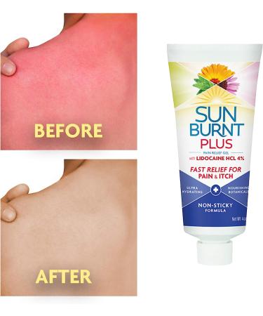 Sunburnt Plus After-Sun Gel 4oz with Lidocaine - Soothes and Relieves Sunburn - Buy Online on GoSupps.com