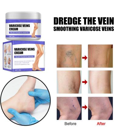 Varicose Veins Cream - Herbal Ointment for Leg Fatigue - Improve Circulation and Eliminate Spider Veins (30g) - Buy Online on GoSupps.com