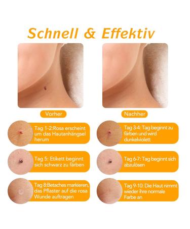 Skin Day Distant Car Skin Tag Remover Kit - 2-in-1 Wart Removal Safe & Painless 40 Day Orange Patches for 2-8 mm Tags - Buy Online on GoSupps.com