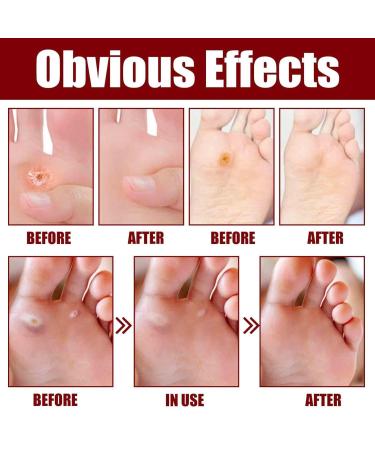 KODEQ Foot Corn Removal Gel Cream - Callus Remover Liquid for All Skin Types - Buy Online on GoSupps.com