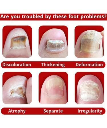 TBeautfave Fungal Nail Treatment Antifungal Nail Treatment Toe Nail Fungal Treatment Fungal Nail Treatment for Toenails Extra Strong Nail Repair and Strengthen Fix & Renew Damaged Broken Nails - Buy Online on GoSupps.com