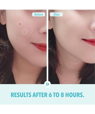 Micro Spot Care Patch - Self-Dissolving Acne Pimple Treatment | Target Zits & Blemishes with Patented 17mm Microdart Technology - Buy Online on GoSupps.com