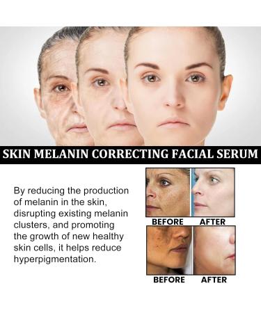 Melanin Correcting Facial Serum | Dark Spot & Vitamin C Serum for Hyperpigmentation Age Spots Melasma - Unisex Solution - Buy Online on GoSupps.com