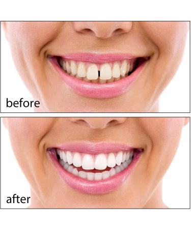 Buy 2 Pairs Snap-In Veneer Teeth - Instant Cosmetic Upper & Lower Dentures for Men & Women | Temporary Smile Solution - Buy Online on GoSupps.com