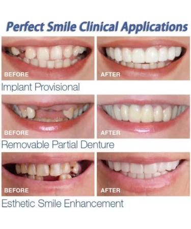 Provisional Dentures | Immediate Smile Teeth Prosthesis | Temporary Upper & Lower Cosmetic Veneers for Bad Teeth - Buy Online on GoSupps.com