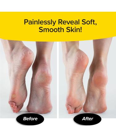 PedEgg Jumbo - As Seen On TV | Effortlessly Remove Calluses & Dry Skin | Easy Reach Handle & 300% More Microfiles for Smooth Feet - Buy Online on GoSupps.com