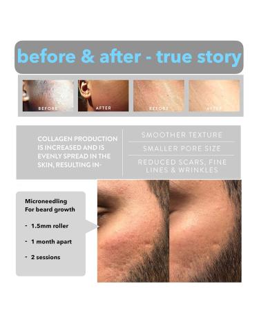 Auduoduo 0.5mm Derma Roller with Real Silver Needles - Microneedling Roller for Skin & Hair Care | 2022 Advanced Seamless Version - Buy Online on GoSupps.com