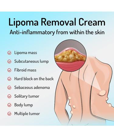 Lipoma Removal Cream 20g - Natural Treatment for Lipoma Care & Discomfort - Buy Online on GoSupps.com
