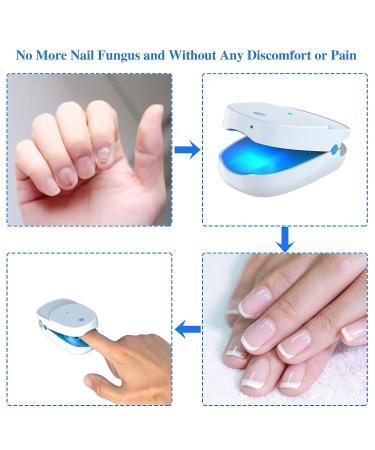 Effective Toenail Fungus Laser Remover Device for Onychomycosis Treatment - Nail & Toe Fungal Cleaning Solution - Buy Online on GoSupps.com