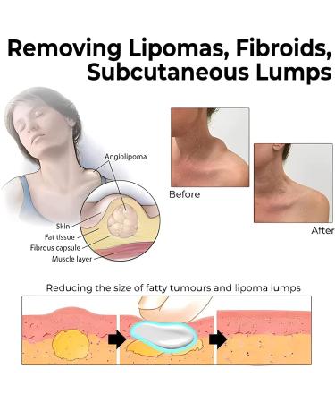 3pcs Lipoma Removal Cream for Anti-Swelling & Cellulite Elimination | Lymphatic Ointment for Lipoma Exfoliation - Buy Online on GoSupps.com
