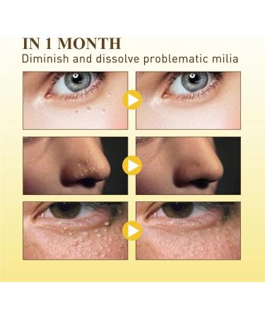 KOAHDE Moisturizing Milia Eyes Cream Speedy Milia Remover Eye Cream Smooth Milia Eyes Cream Milia Removal Eye Creams Dissolve and Reduce Milia Eye Cream Dark Circles Remover Lightens Cream 50G - Buy Online on GoSupps.com