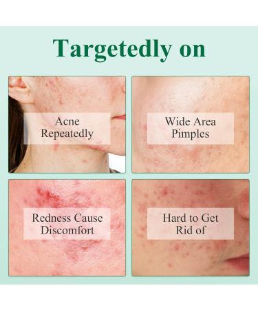 Breylee Tea Tree Oil Serum for Acne Prone/Sensitive Skin - Cystic Acne Treatment, Pimples & Scars Remover, Redness Relief, Niacinamide Moisturizer - Anti-Aging Essence - 30ml/1.01fl oz - Buy Online on GoSupps.com