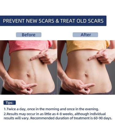 Silicone Scar Gel Cream for Face & Body | Advanced Treatment for Old & New Scars Stretch Marks Burns & Surgery - 30g (1.06 Oz - Buy Online on GoSupps.com