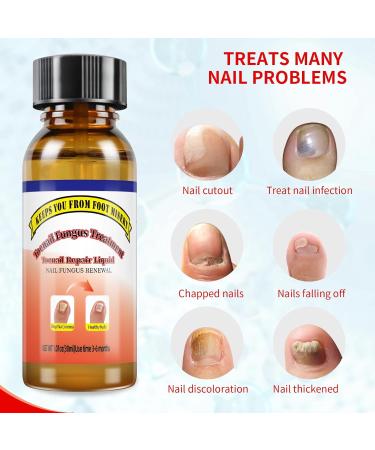 Extra Strength Toenail Fungus Treatment - 30ML Nail Solution with Soft Brush - Transform Your Nails & Boost Confidence - Buy Online on GoSupps.com