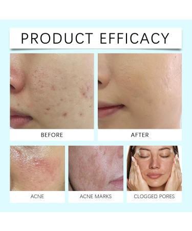 Viareline Acne Care Cream Refreshing Oil Control Comfortable Nourishing Daily Cleansing Facial Acne Skin - Buy Online on GoSupps.com