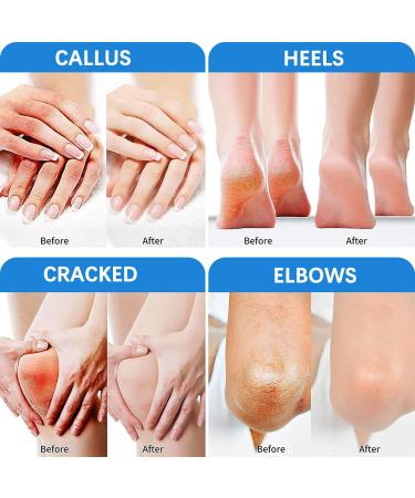 Urea Foot Cream 40% Urea Cream for Cracked Heels Callus Remover For Dry And Hard Skin Deep Moisturizing Cracked Heel Cream for Feet Knees Hand - Buy Online on GoSupps.com