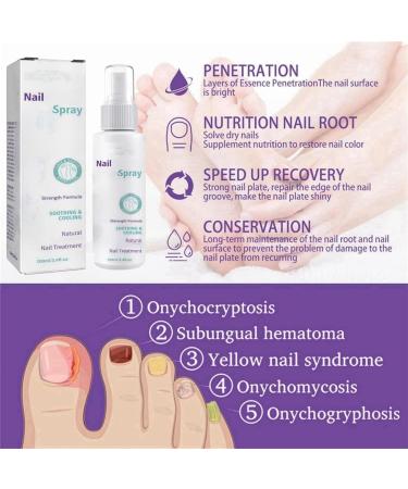 Nail Growth Treatment Toenail And Nail Strengthener Nail Treatment Nail Repair Nail Repair Treatment Fix & Renew Damaged Broken Nails Toe Nail Treatment Broken Nails Yellow Toenail Treatment - Buy Online on GoSupps.com