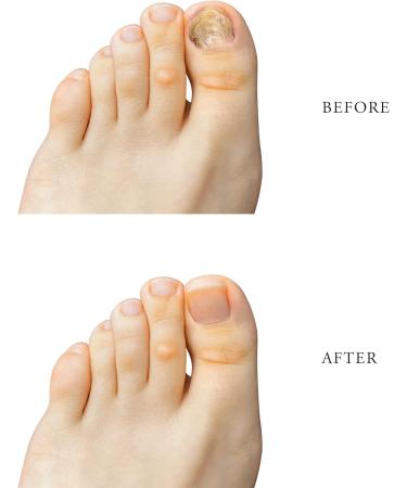 Yanail Extra Strong Nail Fungus Treatment for Toenails - 10ml Anti-Fungal Solution in Reddish Brown (Pack of 1) - Buy Online on GoSupps.com