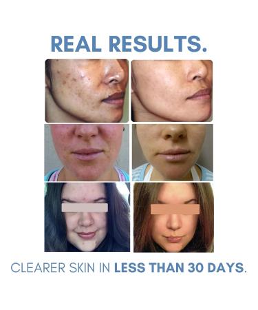 Clarifying Acne Toner - Salicylic Acid Astringent for Oily Skin | 4 Fl Oz Facial Toner for Blemishes & Clear Skin - Buy Online on GoSupps.com