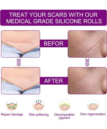 Silicone Scar Removal Tape Roll - Long Strips for Effective Scar Reduction - Buy Online on GoSupps.com