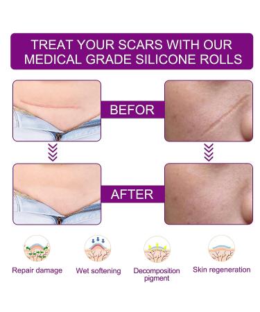 Silicone Scar Sheets - Clear Tape Roll for Effective Scar Removal | Reusable Strips for C-Section Surgery, Keloid, Burn, Acne - 2-1.6 x 60 1.5M - Buy Online on GoSupps.com