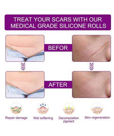 Silicone Scar Sheet for Surgery, Injury, Burns, C-Section - Softens, Flattens Scars - Safe & Painless Removal - 1.6x60 Inch - Buy Online on GoSupps.com