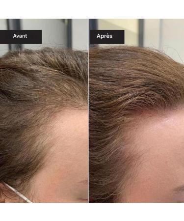Natural Hair Growth Oil Daily Oil Natural Fluid With Vegetable Extracts Scalp Care Promoting Regrowth For Adults Men Women - Buy Online on GoSupps.com