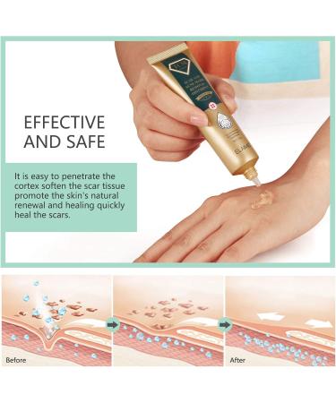 JSBNQRMZ Scar Gel 30g Scar Creme Reduces Scars Visibility & Reduces Tissue Tension & Itching - All Types of Scars - Buy Online on GoSupps.com