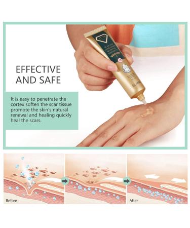 RTBYUE Scar Removal Cream - 2 Pack TCM Cream for Surgical Scars, Acne & Stretch Marks - Buy Online on GoSupps.com