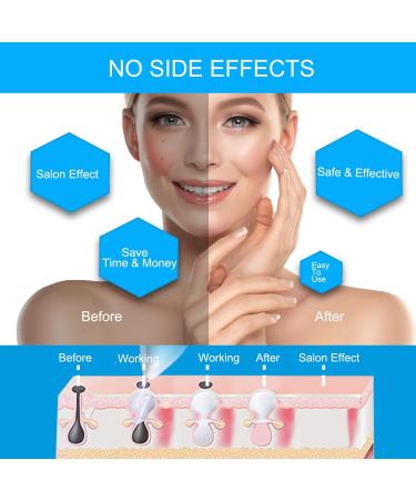 WART & Skin Tag Removal Kit for Women - Model 40226 - Buy Online on GoSupps.com