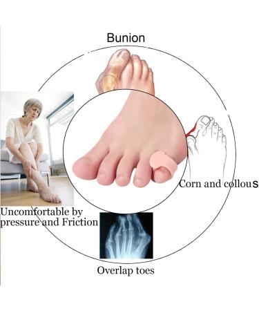 Pinky Toe Splint and Gel Separators for Hammer Toe, Bunion Corrector and Relief - 10 Pcs for Men and Women - Buy Online on GoSupps.com