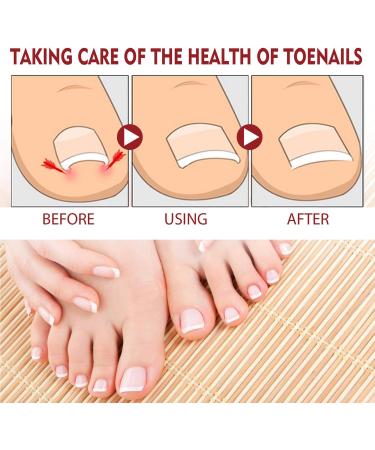 German Toenail Plus Anti Paronychia Relief Oil Anti Paronychia Relief Oil German Toenailplus Anti Paronychia Relief Oil Ingrown Toenail Treatment Nail Repair for Damaged Nails (2) - Buy Online on GoSupps.com