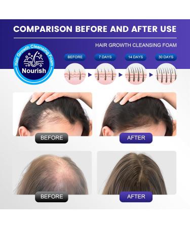 150ml Essence de Soin de Cheveux Mousse G n rique per r duire la fragilit Des Pour des plus pais et plus volumineux Pour Anti Chute Cheveux Femme et Homme Favorise la Pousse des Cheveux Plus pais - Buy Online on GoSupps.com