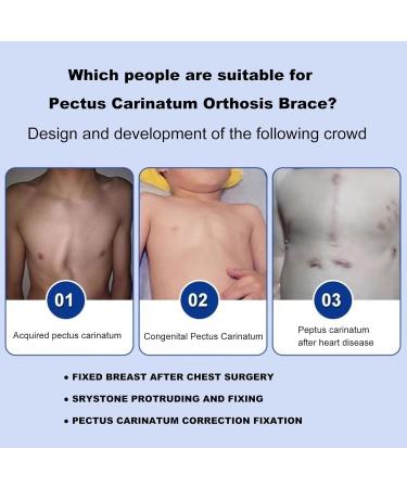 SUZLAZYR Pectus Carinatum Orthosis Brace Thoracic Depression Brace Pigeon Chest Support Medical Ribs Valgus Orthosis Braces Comfortable and Breathable S - Buy Online on GoSupps.com