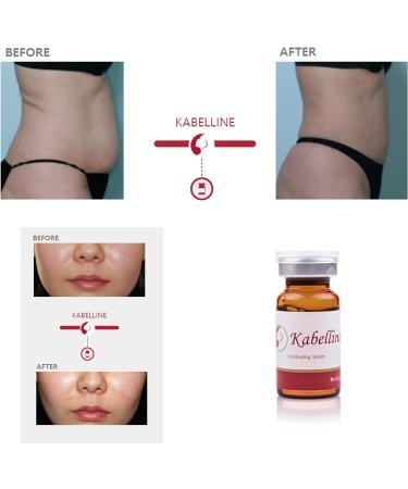Kabelline Permanent Fat & Cellulite Dissolver - 5 Vials | Effective Cellulite Treatment - Buy Online on GoSupps.com