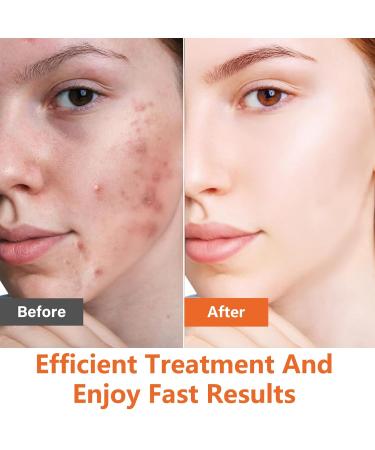 Azelaic Acid Acne Cream with Aloe Extract - Oil Control & Deep Cleaning for Sensitive Skin - Moisturizing Anti-Acne Skin Care - Buy Online on GoSupps.com