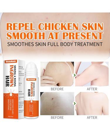 Mombiy Burns & Shave Bump Solution - Care for Ingrown Hair & Skin Irritation | White Unit Size - International Shipping Available - Buy Online on GoSupps.com