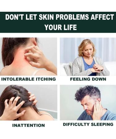 EasPowest Youth Bee New Zealand Professional Bee Venom Psoriasis Treatment Cream Soothing Moisturizing Psoriasis Cream (2PCS) - Buy Online on GoSupps.com