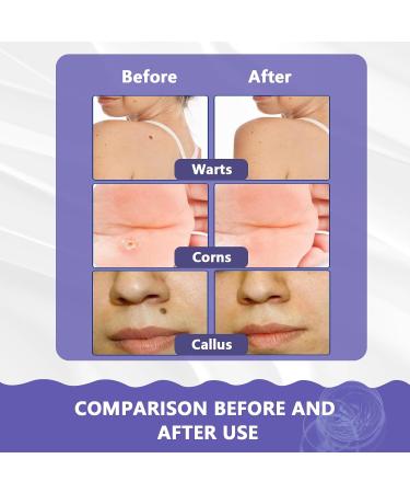 Maximum Strength Wart Remover Liquid with Salicylic Acid - Fast-Acting Wart Treatment for Common Plantar & Genital Warts - 0.68 floz/20ml - Buy Online on GoSupps.com