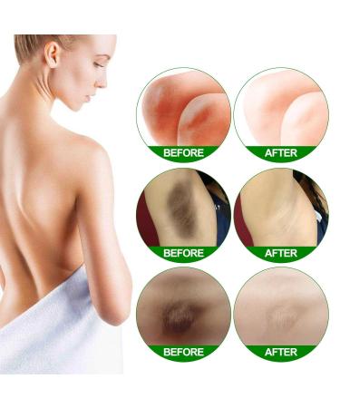 G neric Crema Para Manchas Oscuras En La Cara Crema Para Las Manchas De La Cara 1pcs Para Piel Entrepierna Manchas Codos Piernas Zonas Rodillas Cuello 50ml - Buy Online on GoSupps.com