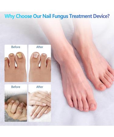 iKeener Portable Cold Laser Nail Fungus Treatment - Rechargeable Home Care Device for Painless Onychomycosis Cure - Buy Online on GoSupps.com