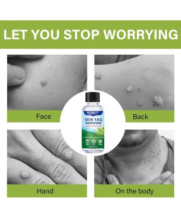 Skin Tag Removal Remover Kit Wart and Mole Remover Verruca Treatment for Hands Face Adults at Home 30ML - Buy Online on GoSupps.com