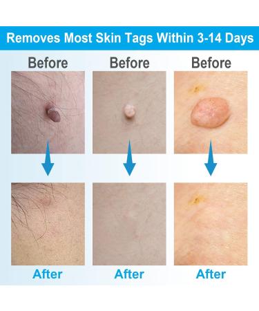 Painless 2-in-1 Skin Tag Removal Kit for Micro to Large Skin Tags (1-9mm) - Safe & Easy DIY Tool for Home Use - Buy Online on GoSupps.com